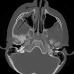 Orbital cellulitis: an axial bone-window CT scan showing left maxillary sinus opacification (arrow) with adjacent orbital and facial soft tissue involvement, the sinugenic source of the infection