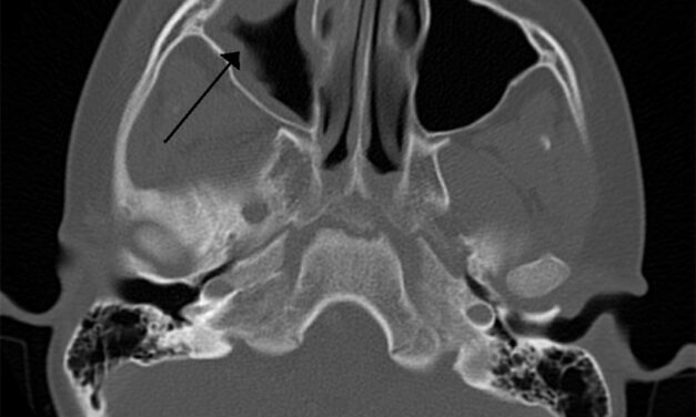 Orbital Cellulitis: Why the Septum Is the Line That Matters