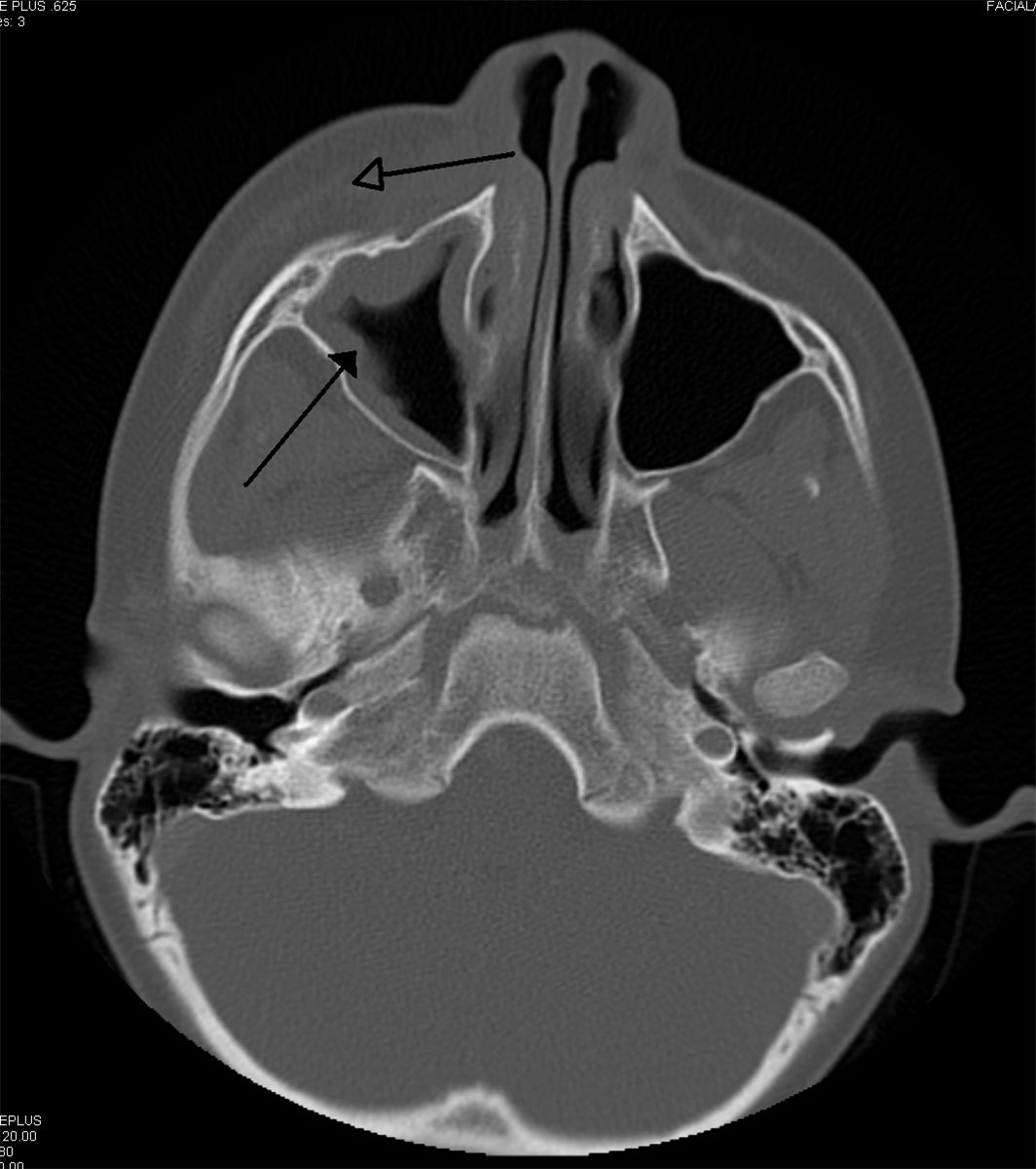 Orbital cellulitis: an axial bone-window CT scan showing left maxillary sinus opacification (arrow) with adjacent orbital and facial soft tissue involvement, the sinugenic source of the infection