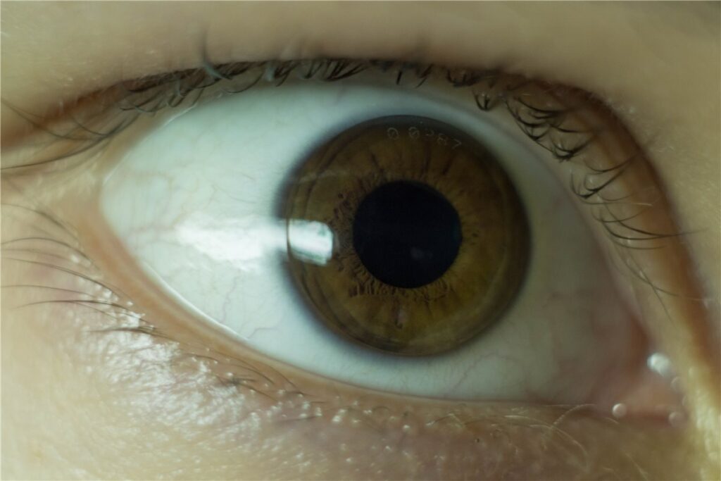 Orthokeratology: a close-up photograph of a rigid gas-permeable orthokeratology lens, with visible engraved markings, fitted on the eye for overnight corneal reshaping