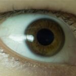 Orthokeratology: a close-up photograph of a rigid gas-permeable orthokeratology lens, with visible engraved markings, fitted on the eye for overnight corneal reshaping