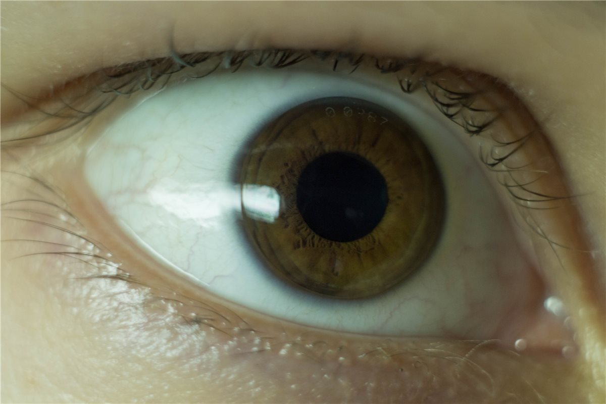 Orthokeratology: a close-up photograph of a rigid gas-permeable orthokeratology lens, with visible engraved markings, fitted on the eye for overnight corneal reshaping