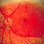 Panretinal photocoagulation: a regular pattern of pale, confluent laser burns spread across the peripheral retina while sparing the macula and the papillomacular bundle
