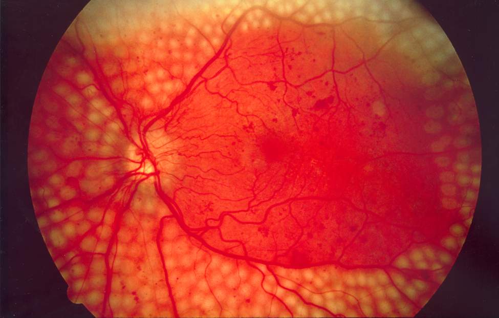 Panretinal Photocoagulation: Still the Standard Against Which New Treatments Are Judged