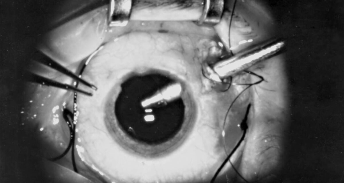 Pars Plana Vitrectomy: The Platform Behind Modern Retinal Surgery
