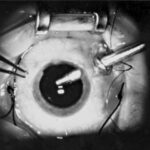 Pars plana vitrectomy: intraoperative view showing surgical instruments introduced through pars plana sclerotomies, with the eye viewed under the operating microscope