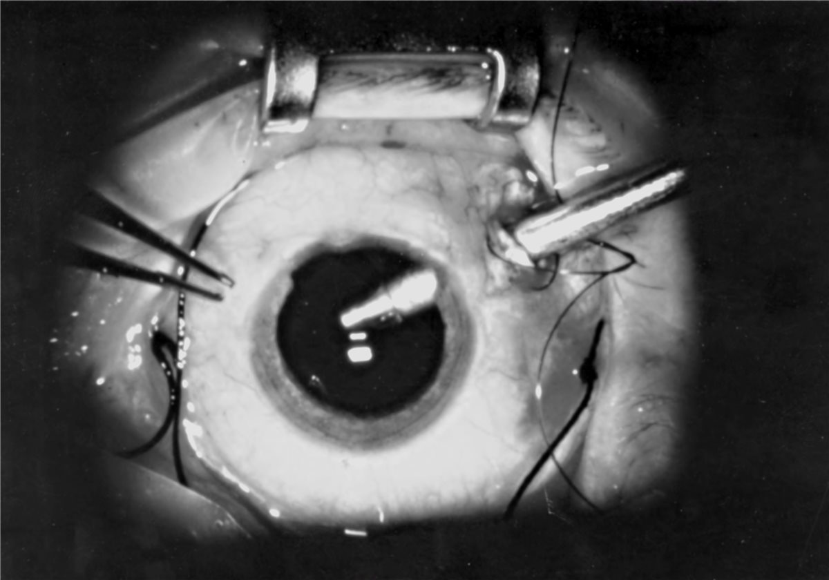 Pars plana vitrectomy: intraoperative view showing surgical instruments introduced through pars plana sclerotomies, with the eye viewed under the operating microscope