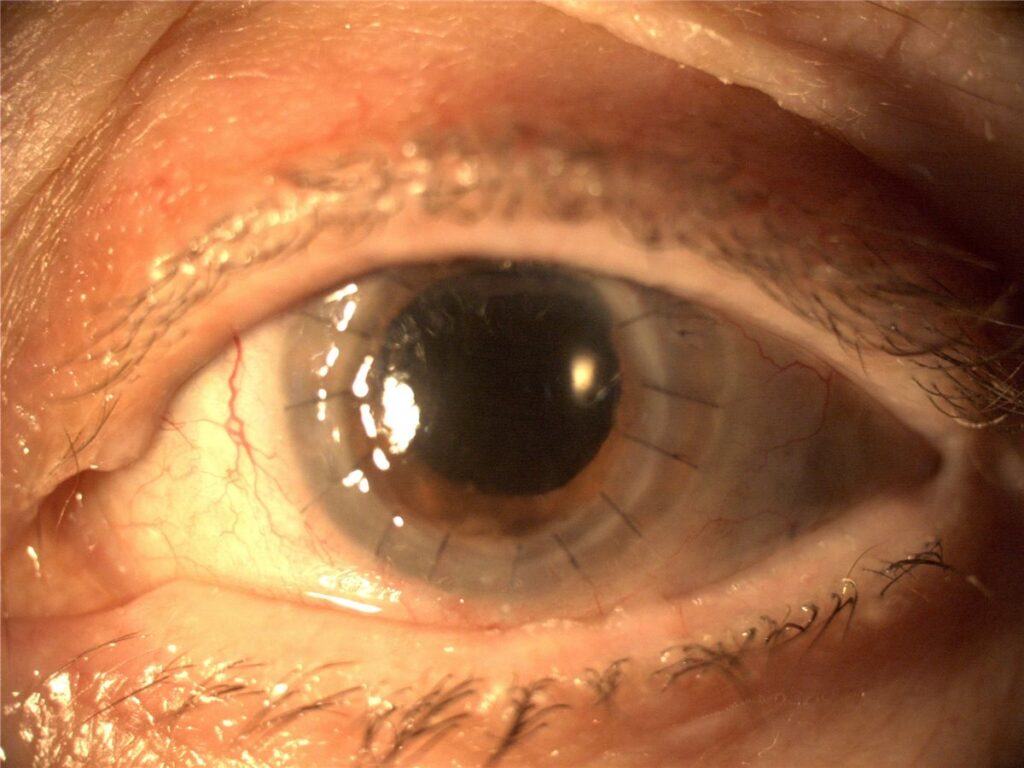 Penetrating keratoplasty: a clear full-thickness corneal graft secured by interrupted sutures visible around the circular graft-host junction