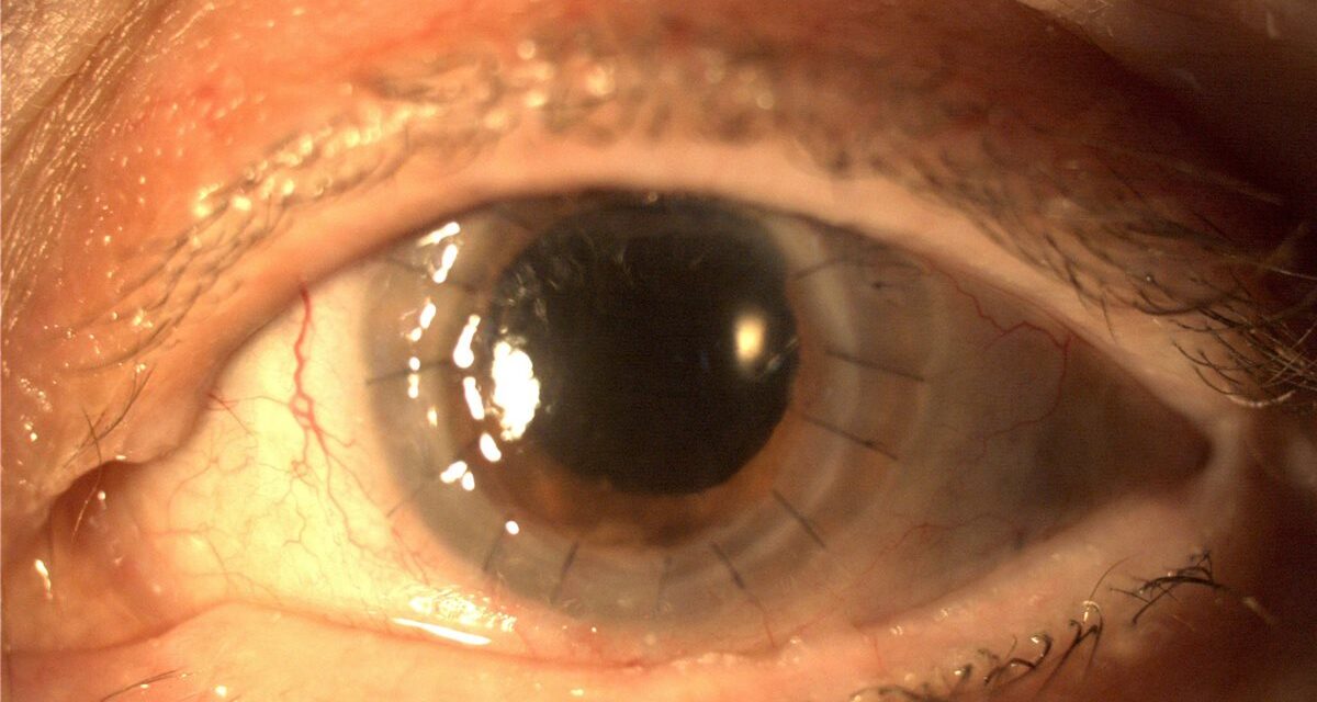 Penetrating Keratoplasty: When Full-Thickness Corneal Transplant Is Still the Answer