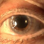 Penetrating keratoplasty: a clear full-thickness corneal graft secured by interrupted sutures visible around the circular graft-host junction