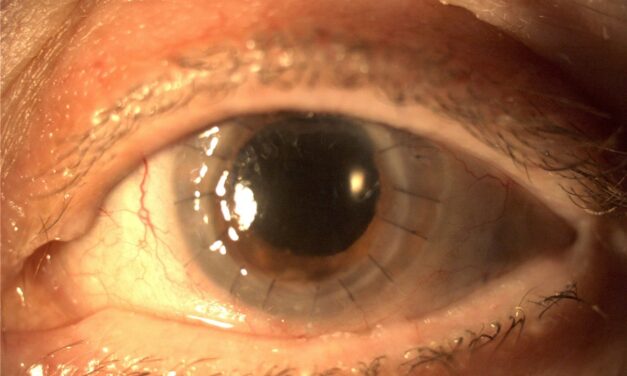 Penetrating Keratoplasty: When Full-Thickness Corneal Transplant Is Still the Answer