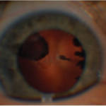 Persistent fetal vasculature: an irregular dark retrolental fibrovascular membrane partially obscuring the red reflex in an affected eye