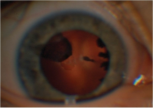 Persistent Fetal Vasculature: When the Eye’s Prenatal Blood Supply Doesn’t Disappear