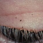 Phthiriasis palpebrarum: an extreme close-up of the eyelid margin showing pubic lice and nits attached at the base of the eyelashes