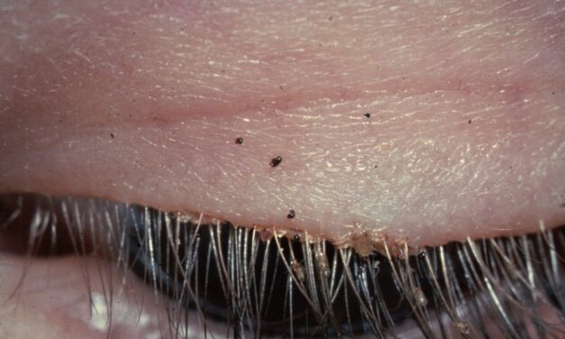 Phthiriasis Palpebrarum: A Blepharitis That Needs a Closer Look