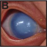 Posterior embryotoxon: slit-lamp photograph with arrowheads marking a prominent, anteriorly displaced Schwalbe line visible as a white ring near the corneal limbus, alongside associated iris coloboma