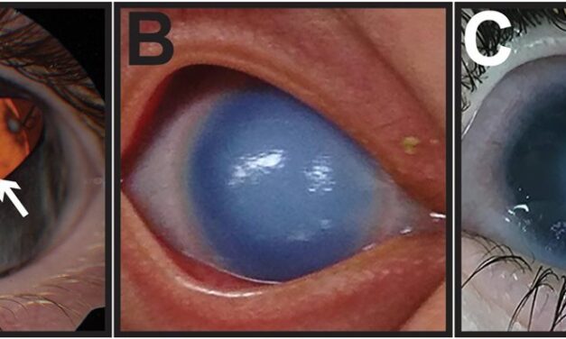 Posterior Embryotoxon: A Corneal Ring That Can Point to the Liver