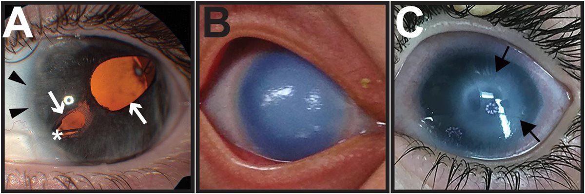 Posterior Embryotoxon - prominent Schwalbe line at the limbus Posterior embryotoxon: slit-lamp photograph with arrowheads marking a prominent, anteriorly displaced Schwalbe line visible as a white ring near the corneal limbus, alongside associated iris coloboma