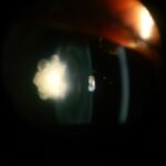 Posterior polar cataract: dense, discrete opacity at the posterior pole of the lens