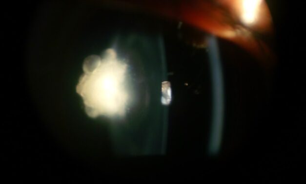 Posterior Polar Cataract: A Small Opacity With a Big Surgical Risk