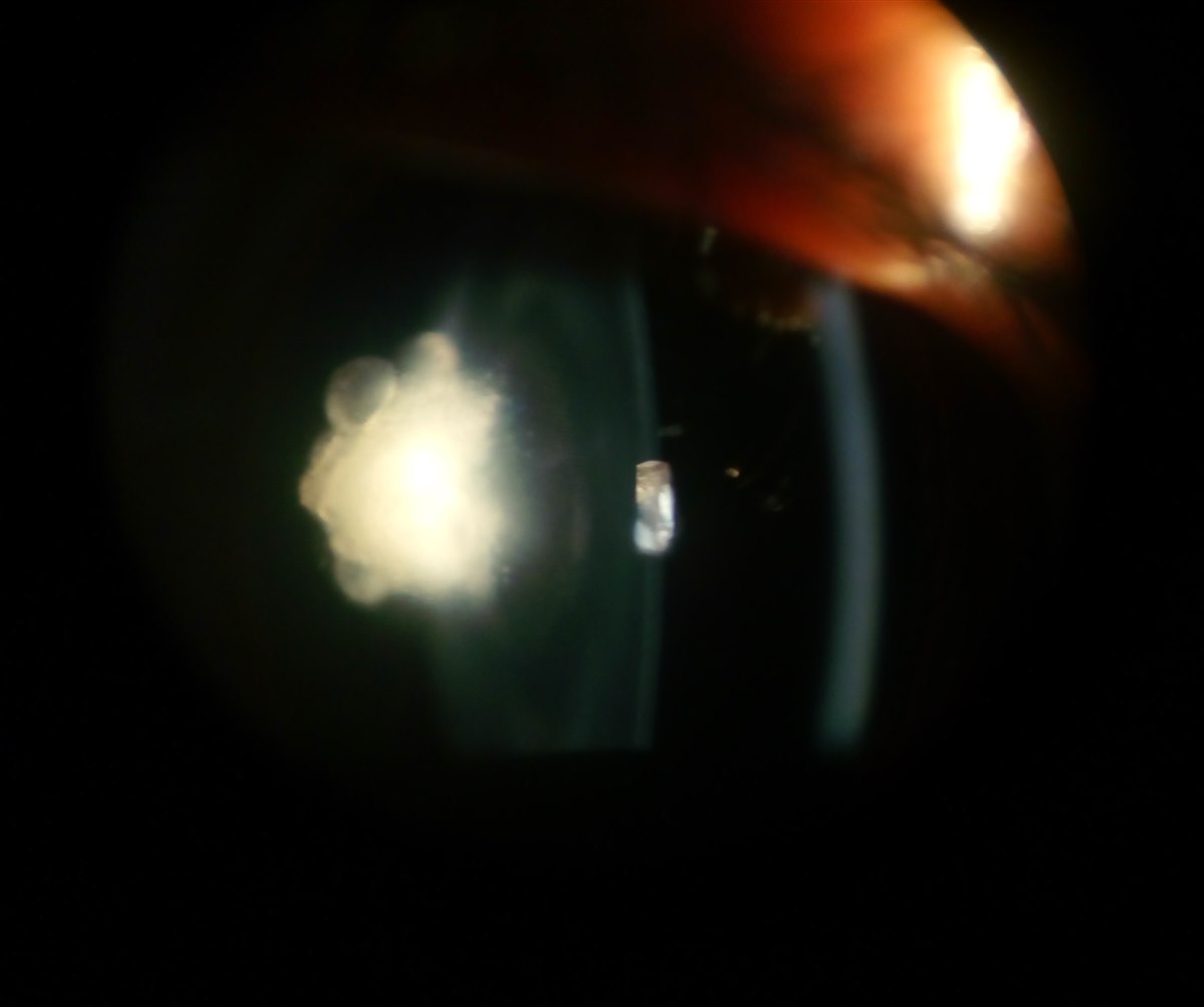Posterior Polar Cataract Posterior polar cataract: dense, discrete opacity at the posterior pole of the lens