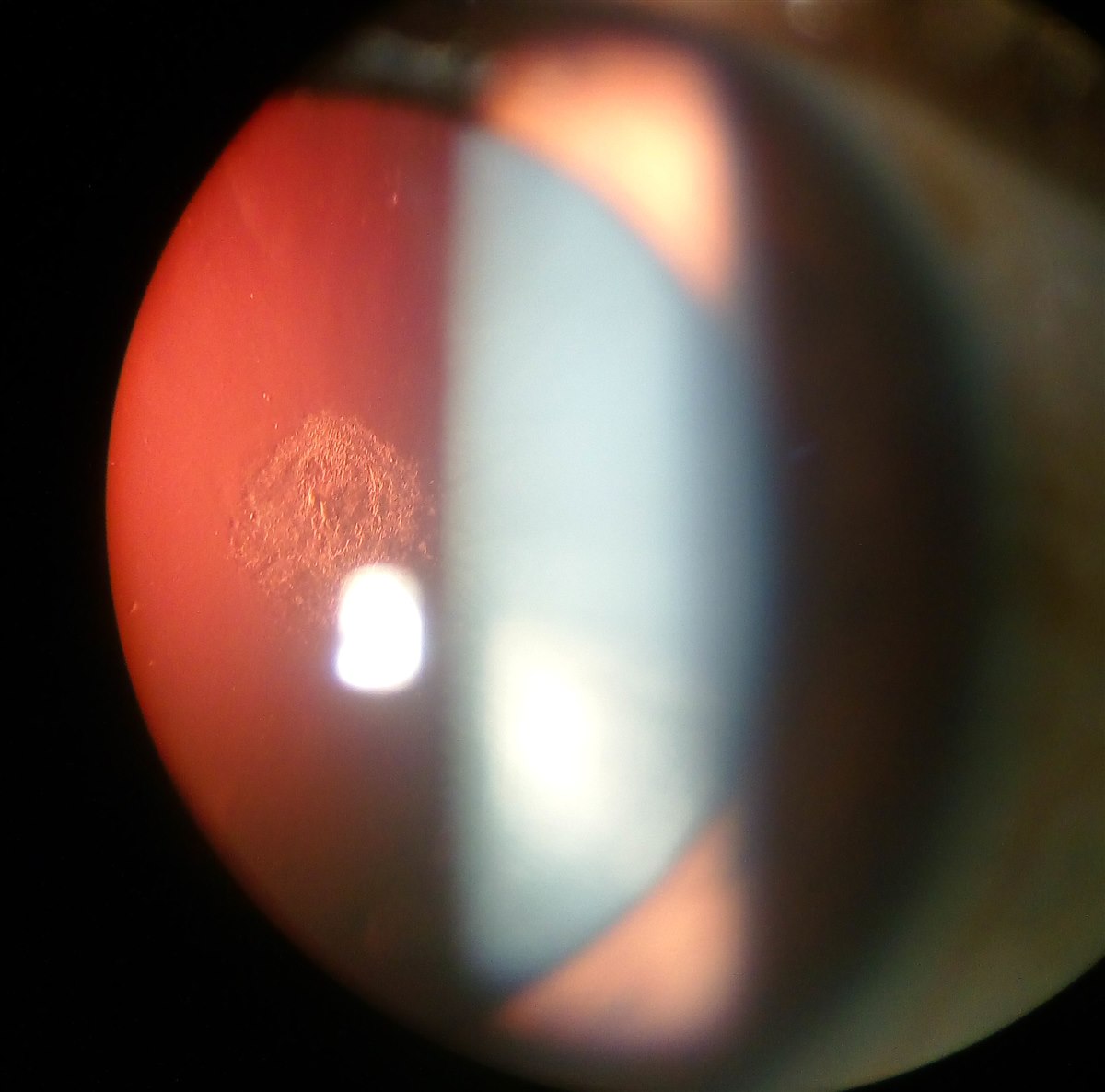 Posterior subcapsular cataract: granular plaque-like opacity at the back of the lens on retroillumination