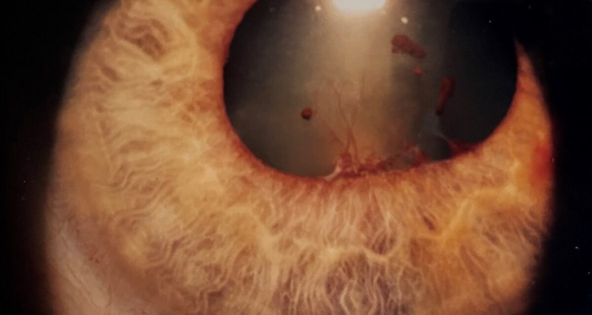 Posterior Synechiae: From Uveitis to Iris Bombe