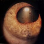 Posterior synechiae: vascularized adhesions between the iris and lens distorting the pupil margin