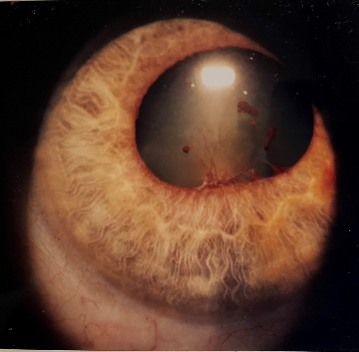 Posterior synechiae: vascularized adhesions between the iris and lens distorting the pupil margin