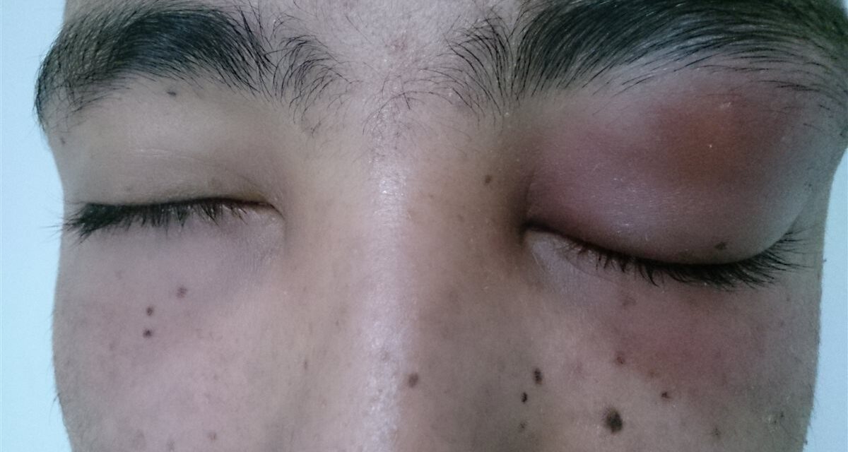 Preseptal Cellulitis: Eyelid Infection That Isn’t (Yet) an Emergency