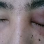 Preseptal cellulitis: marked unilateral upper and lower eyelid swelling with violaceous erythema, eyelid still able to close, without proptosis