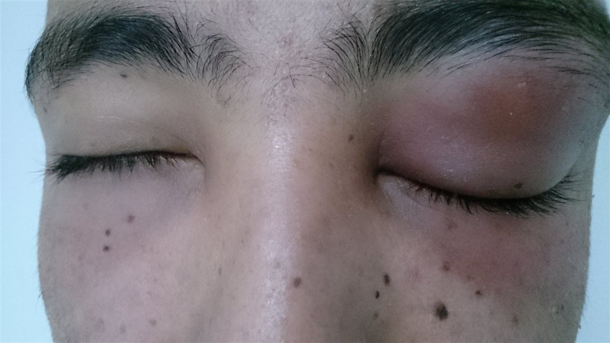 Preseptal cellulitis: marked unilateral upper and lower eyelid swelling with violaceous erythema, eyelid still able to close, without proptosis