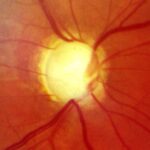 Primary open-angle glaucoma: fundus photograph showing an enlarged, pale optic disc cup with markedly thinned neuroretinal rim and nasalized vessels, consistent with advanced glaucomatous cupping