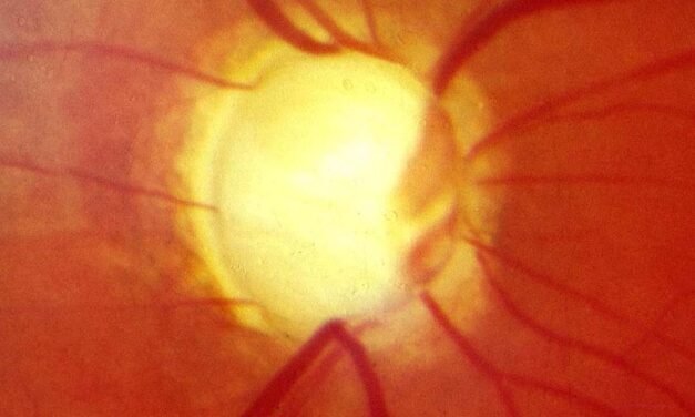 Primary Open-Angle Glaucoma: Why It Remains the Silent Thief of Sight