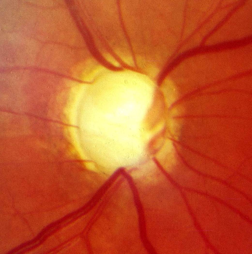 Primary open-angle glaucoma: fundus photograph showing an enlarged, pale optic disc cup with a markedly thinned neuroretinal rim and nasalized retinal vessels, consistent with advanced glaucomatous cupping