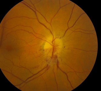 Foster Kennedy Syndrome: When Optic Atrophy Meets Papilledema