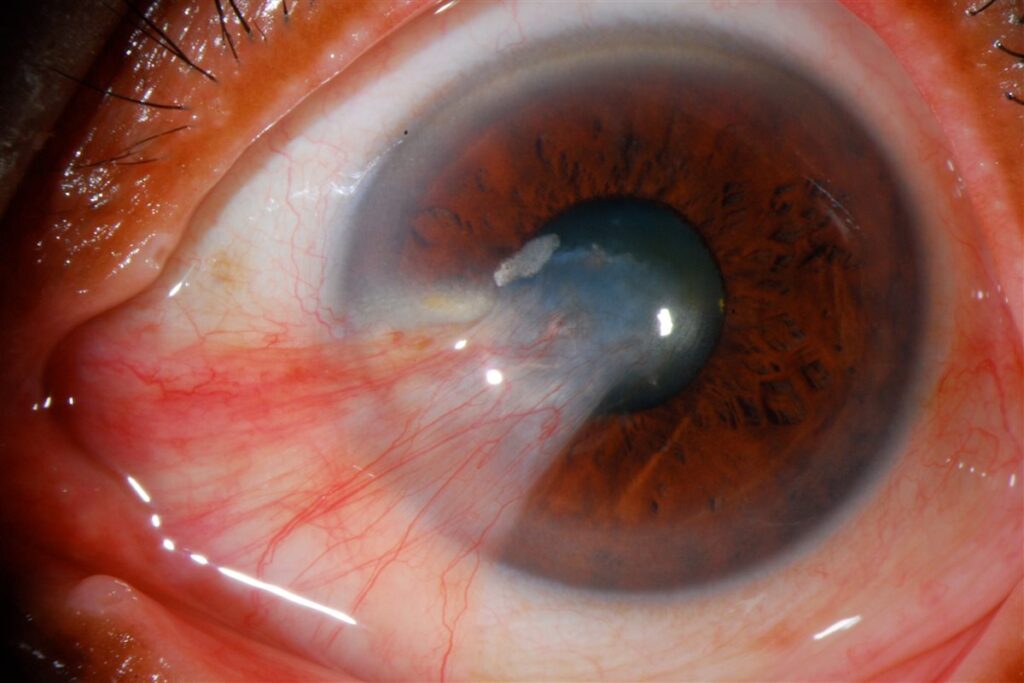 Pterygium: triangular fibrovascular conjunctival tissue extending onto the nasal cornea