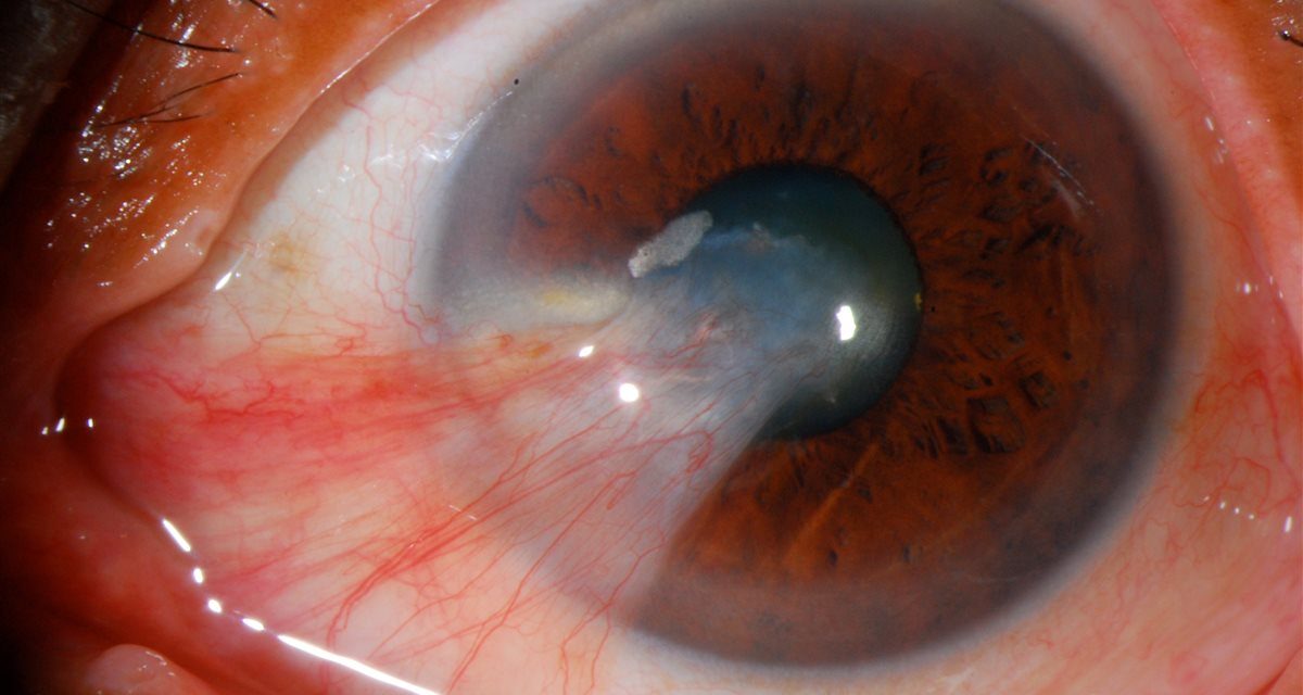 Pterygium: Why This Common Ocular Surface Lesion Deserves a Careful Look
