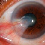 Pterygium: triangular fibrovascular conjunctival tissue extending onto the nasal cornea