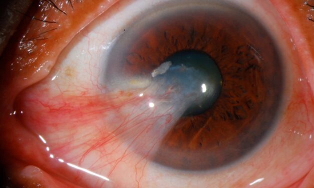 Pterygium: Why This Common Ocular Surface Lesion Deserves a Careful Look