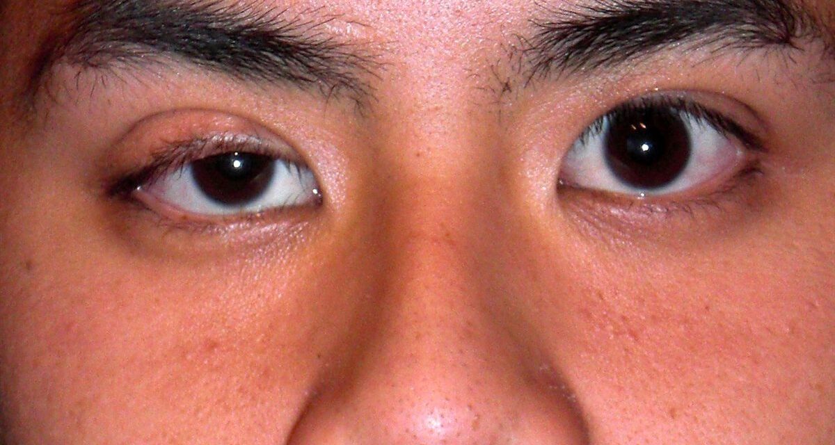 Ptosis: The Eyelid Droop That’s Rarely Just Cosmetic