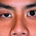 Ptosis: unilateral drooping of the upper eyelid margin covering more of the iris and pupil compared to the normal contralateral eye