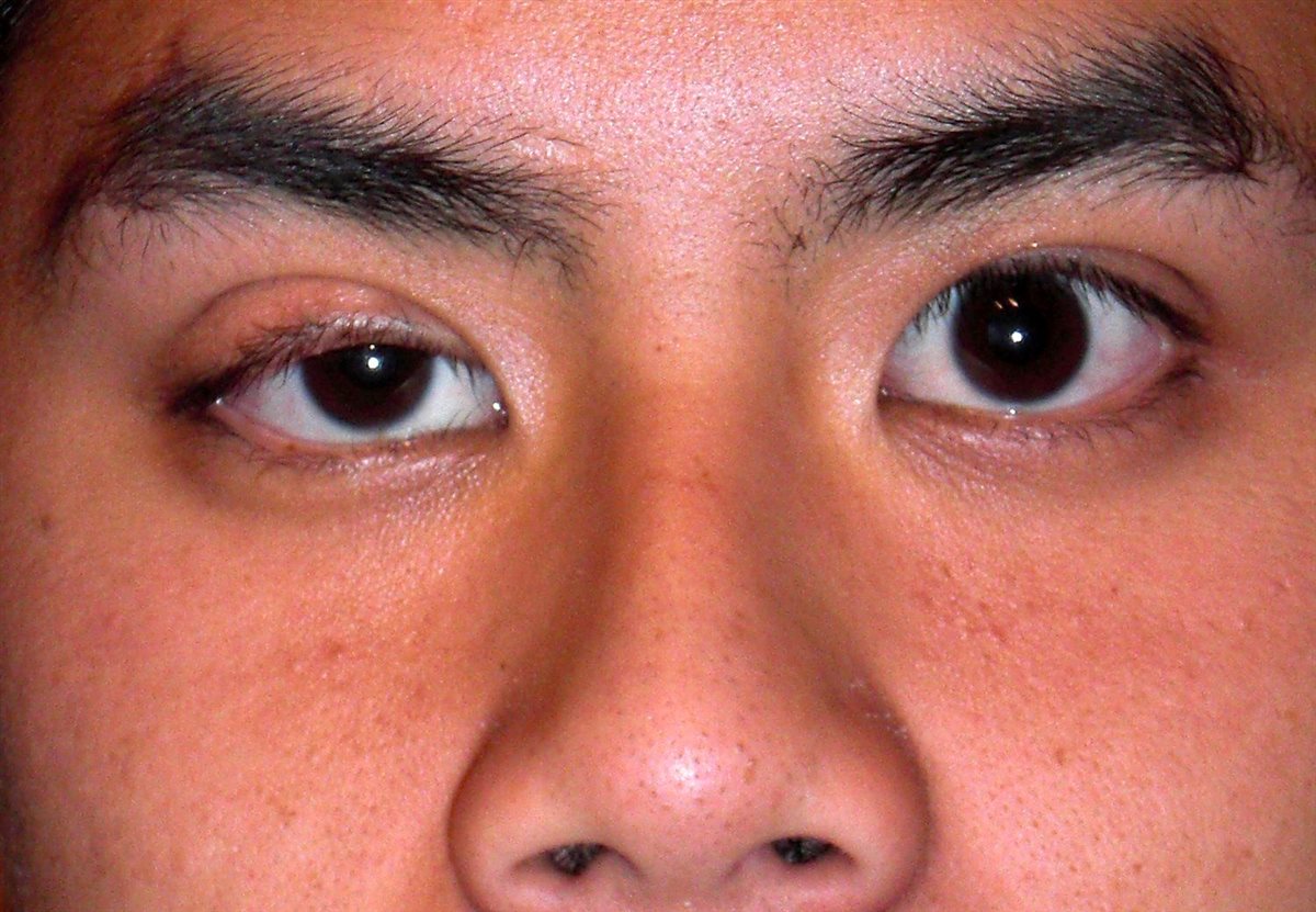 Ptosis: unilateral drooping of the upper eyelid margin covering more of the iris and pupil compared to the normal contralateral eye