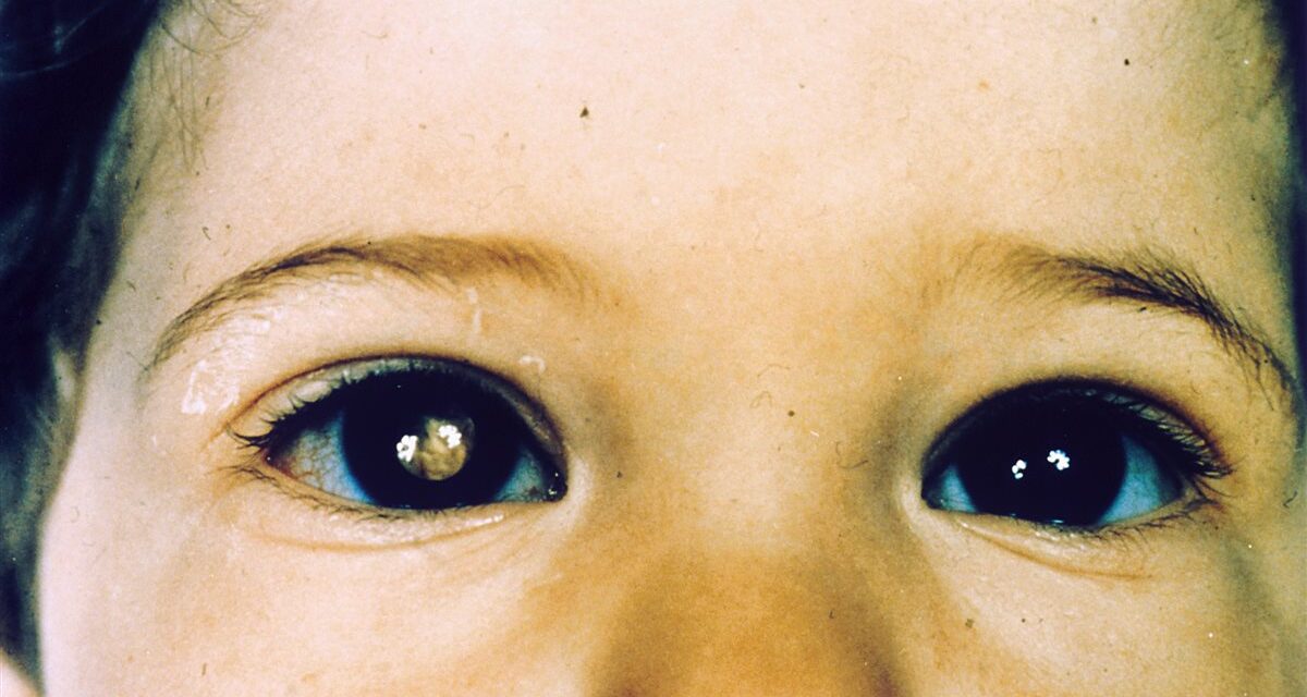 Retinoblastoma: The Cancer a Photograph Can Reveal