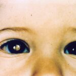 Retinoblastoma: unilateral leukocoria showing a white pupillary reflex in the affected eye compared to the normal red reflex in the fellow eye