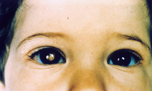 Retinoblastoma: The Cancer a Photograph Can Reveal