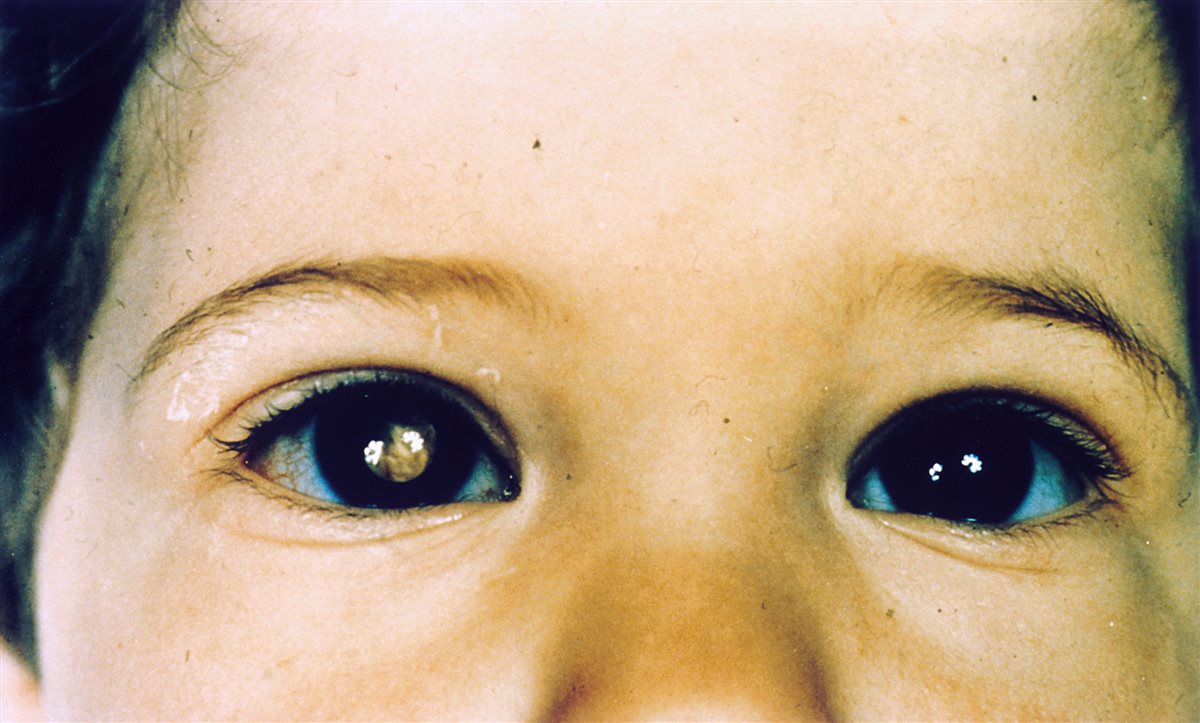 Retinoblastoma: unilateral leukocoria showing a white pupillary reflex in the affected eye compared to the normal red reflex in the fellow eye