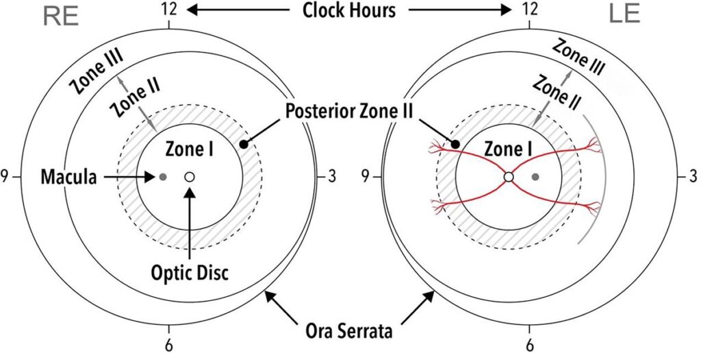 Retinopathy of prematurity classification: diagram of the right and left eyes showing zone I, zone II, posterior zone II and zone III boundaries with clock-hour sectors used to describe the extent of disease