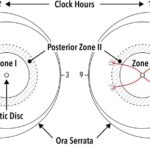 Retinopathy of prematurity classification: diagram of the right and left eyes showing zone I, zone II, posterior zone II and zone III boundaries with clock-hour sectors used to describe the extent of disease
