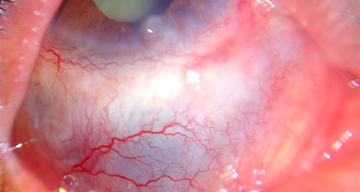 Scleritis: The Deep, Boring Pain That Isn’t Episcleritis